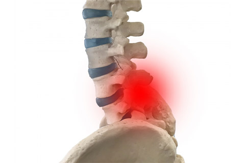 椎間板ヘルニア